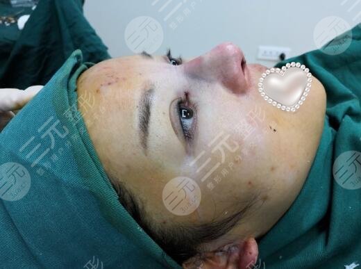 最新隆鼻手術(shù)，重塑鼻型，找回自信