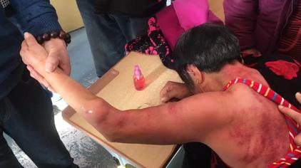 最新擰痧步驟指南與操作詳解